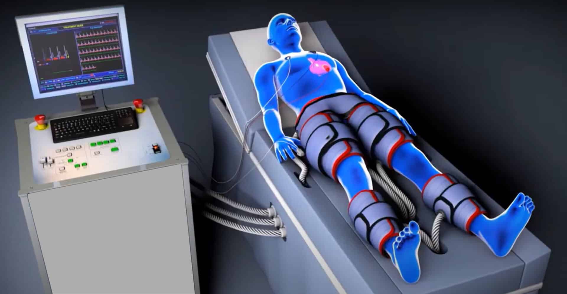 EECP Treatment
